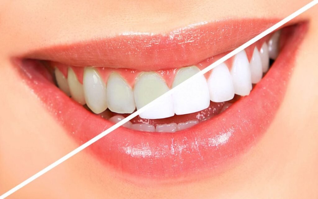 Clareamento dental em Niteroi