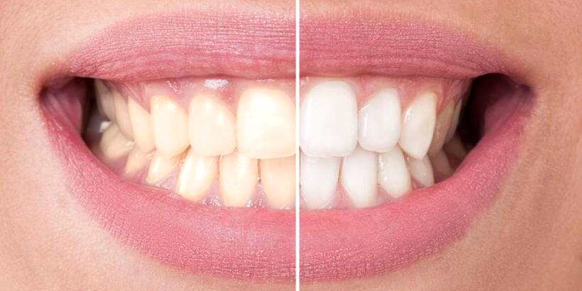 clareamento de dentes - Clareamento dentário, descubra o poder deste tratamento na Souza Costa Odontologia!